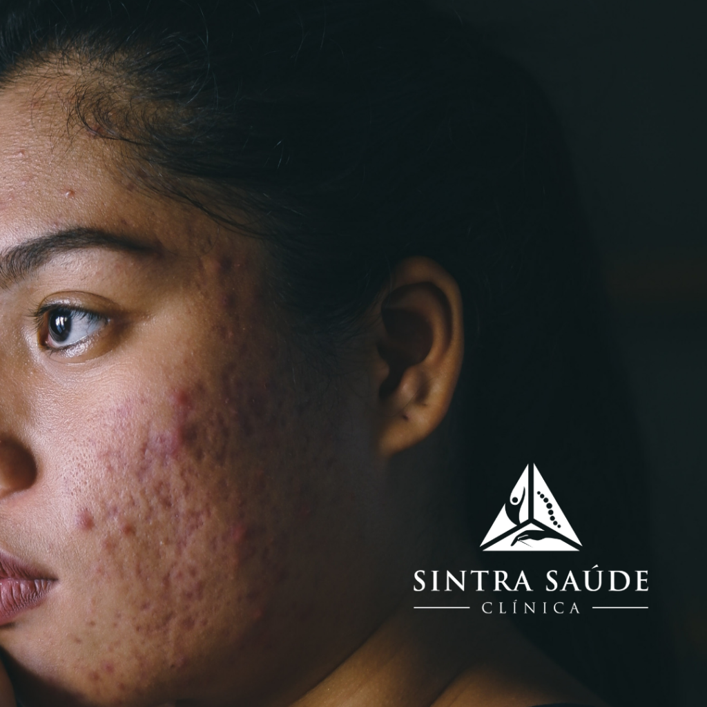 paciente de perfil com marcas de acne, com fundo preto